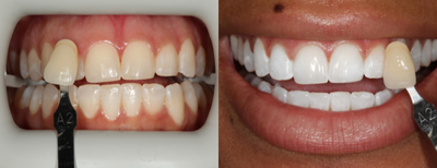 25-34 year old woman treated with Zoom Whitening - Zoom Whitening before and after