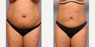 Smartlipo Liposuction of Tummy and Flanks - This is a 38-year-old woman who told me that she had just given up trying to lose weight and get her old 25-year-old body back. She hadn't gained any weight for the past three years or so, but she couldn't seem to shake off the pounds either. About a year before coming to me, she had trialed a full series of Zerona treatments but told me that it didn't work at all. She asked me to give her a waistline but said she needed an affordable solution.

She had surprisingly good skin tone with no hanging tissues. I told her that I thought I could probably get her a nice result with much of the benefit of a tummy tuck but without the expense or recovery time required. It's not that I don't like performing abdominoplasties, but in THIS case (because of her good skin) I thought liposuction was a good alternative.

I performed Smartlipo liposuction of her tummy and back under local anesthesia. In total we removed 2,500 cc of fatty aspirate. She had a typical recovery and was back at work in 3 days. Her postoperative photos were taken 3 months after the liposuction was performed.