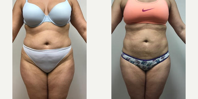 35-44 year old woman treated with Liposuction - 36 year old shown before and two months after liposuction of the abdomen and hips. Patient is 5'2 tall and weighs 180 pounds.