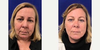 55-64 year old woman treated with Voluma - My 55 year old patient was not happy with her tired appearance. She didnt want anything surgical but wanted to look refreshed. Here she is after Botox in the forehead and crows feet area, Voluma in her cheeks to add volume and lift the lower face, and Belotero in the tear trough (undereye area) & peri oral lip lines. 2 weeks later, she looks refreshed & rejuvenated. Her other non-invasive options going forward are C02 Laser & full face & neck Ultherapy.
