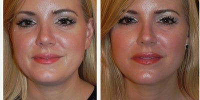 35-44 year old woman treated with Kybella - This generous patient allowed us to share her photos. She had 2 Kybella treatments and received a nice result.