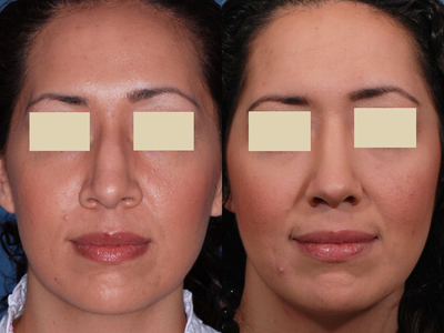 Rhinoplasty - 
	This Hispanic Rhinoplasty patient underwent open primary rhinoplasty in Dallas, Texas to correct her wide bridge and lower her dorsal hump. An alar base reduction corrected her wide and flaring nostrils.
