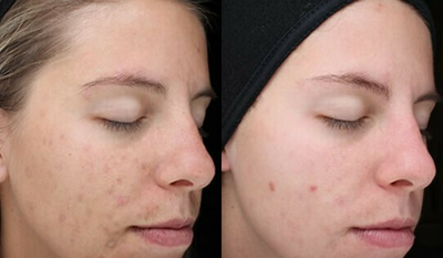 Woman treated with VI Peel - After 2 VIPurify Peels