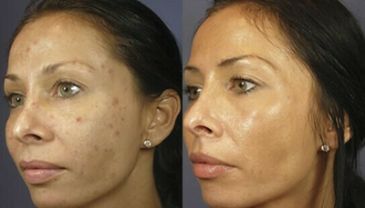 Woman treated with VI Peel - Woman treated with VI Peel
