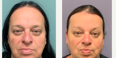 45-54 year old woman treated with Rhinoplasty, Septoplasty, Transgender Facial Feminization Surgery, Forehead Reduction, Brow Li - This is a lady who underwent forehead reconstruction (browlift, scalp advancement, and bone reduction) and septorhinoplasty.