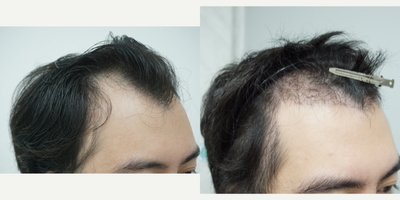 25-34 year old man treated with DHI Hair Transplant, FUE Hair Transplant, Hair Transplant - A middle-aged Asian man came in for a FUE hair transplant with 3,300 grafts to restore his frontal, temples and crown. We also add more grafts on his right temple to cover his surgical scar.