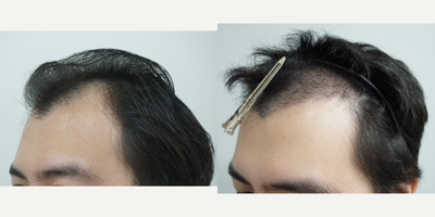 25-34 year old man treated with DHI Hair Transplant, FUE Hair Transplant, Hair Transplant - A middle-aged Asian man came in for a FUE hair transplant with 3,300 grafts to restore his frontal, temples and crown. We also add more grafts on his right temple to cover his surgical scar.