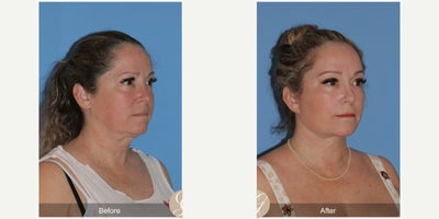 45-54 year old woman treated with Deep Plane Facelift, Neck Lift, Brow Lift, CO2 Laser, MACS Facelift - 52 year old treated with Deep Plane Face and Neck Lift, Temporal Brow Lift, CO2 Laser of Face, MAC
