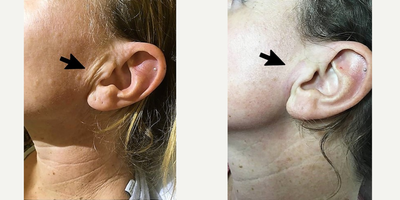 Woman treated with Plasma Fibroblasting - This woman had excess skin near her ears. Using Plexr plasma exeresis we vaporated the excess skin permanently, giving her smooth skin without lines.