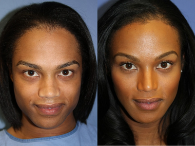 25-34 year old woman treated with Facial Feminization Surgery - Forehead Reduction with Browlift and Hairline Advancement; Rhinoplasty; Tracheal Shave; Jaw Reduction; Cheek Implants