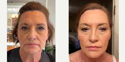 55-64 year old woman treated with Xeomin - 16 units of Xeomin treatment to the lower face and platysma.