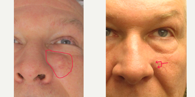 66 year old man treated with Cyst Removal - 66 year old male before and 3 weeks after removal of complex left midface cyst he had for 20 years that kept enlarging. He is happy with the small scar because he saw another surgeon his primary care physician referred him to that was going to give him a scar four times longer. He has not used any scar product or had any laser treatments after his surgery.
