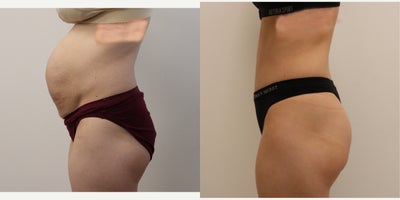 35-44 year old woman treated with Tummy Tuck, Diastasis Recti Repair, Umbilical Hernia Repair - This busy mom sought tummy tuck with diastasis repair after pregnancy with twins. She had her core muscles restored to the proper position and is thrilled! Shown here 6 months after surgery. (A small umbilical hernia was repaired as well)