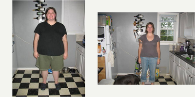 25-34 year old woman treated with Gastric Bypass - Post gastric bypass patient 1 year post operatively.