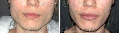 Jaw - 	Non-surgical Jaw Reduction