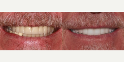 Man treated with KoR Teeth Whitening - Man treated with KoR Teeth Whitening