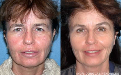 Woman treated with Blue Peel - Obagi Blue Peel and Thermage