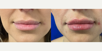 18-24 year old woman treated with Volbella - Volbella lip filler immediately after injection. By Steve