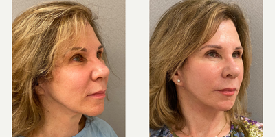 55-64 year old woman treated with Facelift, SMAS Facelift, Neck Lift, Facelift Revision - 62 yo s/p secondary facelift in our on site AAAA certified operating suite under local anesthesia with sedation.