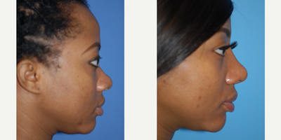 25-34 year old woman treated with African American Rhinoplasty - Rhinoplasty to build up the bridge and improve the dorsal line.