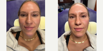 25-34 year old woman treated with Dermal Fillers, Vollure - RHA Filler- Filling of smile lines around the mouth and filling of nasolabial folds.