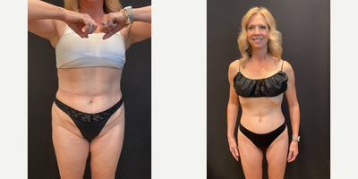 Woman treated with Semaglutide - Woman treated with Semaglutide