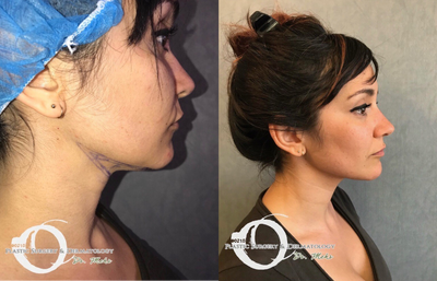 18-24 year old woman treated with Liposuction - Chin, inner thigh, and inner knee liposuction