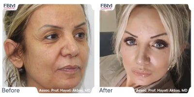 45-54 year old woman treated with Facelift, Deep Plane Facelift, Facial Fat Transfer, Rhinoplasty, Eyelid Surgery - 45-54 year old woman treated with Facelift, Deep Plane Facelift, Facial Fat Transfer, Rhinoplasty, Eyelid Surgery