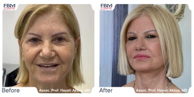 55-64 year old woman treated with Deep Plane Facelift, Facelift, Facial Fat Transfer, Eyelid Surgery - 55-64 year old woman treated with Deep Plane Facelift, Facelift, Facial Fat Transfer, Eyelid Surgery