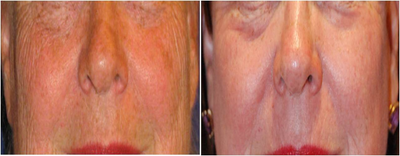 CO2 Laser Resurfacing ~ Active & Deep FX - Before &amp; After PhotosActive &amp; Deep FX CO2 Laser Resurfacing of the whole face.