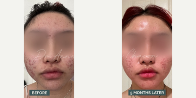 Woman treated with Accutane - Woman treated with Accutane