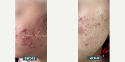 Woman treated with Accutane - Woman treated with Accutane