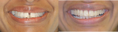 Adult Orthodontics with Clear Braces - 50 year old lady with gaps between top front teeth. Patient was treated with Cfast clear braces for 6 months. Gaps were closed and patient received bonded retainer