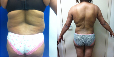 35-44 year old woman treated with Tummy Tuck - Mommy Makeover Before and After Pictures