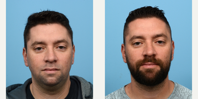 35-44 year old man treated with Chin Implant, Chin Liposuction - 35-year-old patient with a smaller, recessed chin. Dr. Wise performed a chin implant along with liposuction for a more defined jawline and balanced profile. 5 months post-op he is thrilled with his results.
