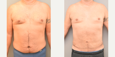 46 year old man treated with Tumescent Liposuction - SAFE Liposuction abdomen and flanks