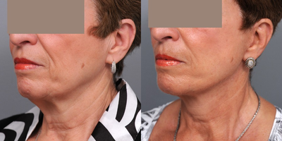 Lower Facelift New York City - After a consultation with Dr. Sterry, this patient chose a facelift.  A full SMAS advancement was performed in an effort to give her a smooth and tension-free result with scars that would heal well.

The SMAS layer is a connective tissue and fatty layer that lies just under the skin. By completely elevating and advancing this tissue superiorly, Dr. Sterry is able to change the architecture of the face. This also allows him to close the skin wounds without any tension at all, leading to a much more natural appearance postoperatively. The skin does not look pulled, and the scars remain hidden.