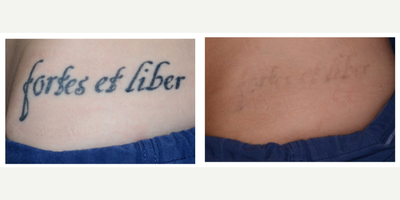 25-34 year old woman treated with PicoWay - Laser tattoo removal