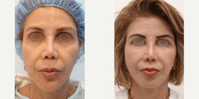 65-74 year old woman treated with Facelift, MACS Facelift - A female patient underwent a facelift procedure in 2025 by Dr. Charles Lee in San Francisco, CA, with remarkable, natural results. The patient experienced a positive outcome, evident through the rejuvenated appearance, improved facial contours, and enhanced self-confidence. The successful surgery by Dr. Lee brought a natural and youthful look to the patient, showcasing his expertise and the patient's satisfaction with the outcome.