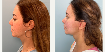45-54 year old woman treated with Facelift, Lower Facelift, Eyelid Surgery - Female patient treated with facelift and upper blepharoplasty.