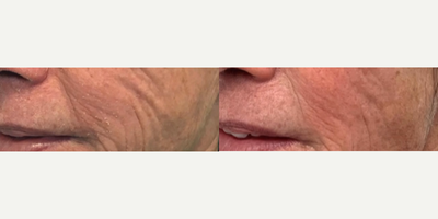 Woman treated with Microneedling RF - We love these incredible results after only a month and a half after just ONE virtue RF treatment!Results will continue to improve over this patients series of three treatments.What is the VirtueRF?VirtueRF combines micro needling with radiofrequencyto rejuvenate the skin and stimulate collagen production to help:Reduce fine lines + wrinklesImprove acne scars + stretch marksTighten loose skinMinimize pore sizeEnhance skins tone + texture