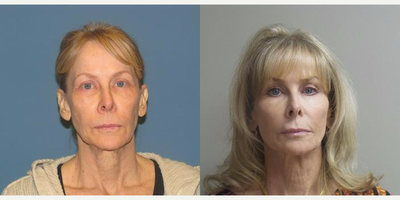 55-64 year old woman treated with Laser Resurfacing - Results 1 yr post resurfacing