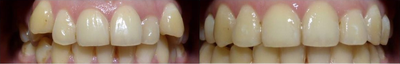 Damon Braces - Patient originally attended as she was unhappy with her&nbsp;smile, particularly the canines. We discussed all the&nbsp;options with the patient, offering her&nbsp;veneers, crowns and braces. After Discussing the risks and benefits of each procedure and the costs, we came to the conclusion that orthodontics would be the best choice. With the Damon braces system there is a choice of clear brackets or metal and it is dependent on the clients choice.This choice then reflects in the cost of the appliance. The length of time you will need to wear this appliance, is dependent on the amount of work needed and the amount of movement needed for the ideal result. After you have finished with the fixed appliance in most cases we would fit a fixed retainer to the back of the teeth to prevent movement, you may also need to wear removable appliances in the evening time we include the removable appliance cost in the full costing at the first appointment. &nbsp;This result was achieved in 8 months, the Damon brace system varies&nbsp;between 6 months to&nbsp;2 years&nbsp;depending on the complexity of the case.