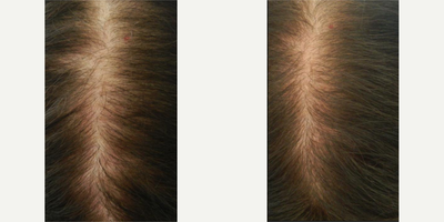 45-54 year old woman treated with Carboxytherapy - After 6 weekly carboxy treatments for hair regrowth.