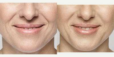 35-44 year old woman treated with Restylane Silk - Before and after lip augmentation with Restylane Silk.