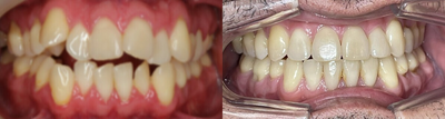 Man treated with Braces - Severe crowding and retruded chin corrected with braces and jaw surgery. Extraction of premolars were required to make space for alignment of teeth.