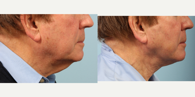 65-74 year old man treated with Renuvion Powered by J-Plasma of his neck for dermal tightening - 68 year-old male treated with Jplasma of neck for dermal tightening combined with liposuction for correction of his turkey neck.
Renuvion Powered by J-Plasma&trade; is a revolutionary minimally invasive procedure that uses cold helium plasma energy on the underside of the skin to instantly tighten and rejuvenate anywhere on the face and body. A unique alternative to traditional facelifts, tummy tucks and body sculpting, the J-Plazty&trade; procedure will shrink and sculpt loose and lax skin without large incisions, downtime or the complications of cosmetic surgery.