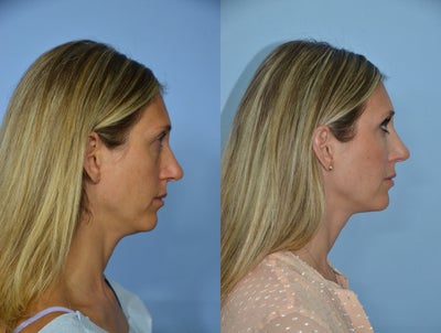 Fat Transfer to Face - 37 year old female who is 3 months after undergoing a transfer to the face, specifically to the temporal gulf, supraorbital rim, infraorbital rim, as well as the cheeks.