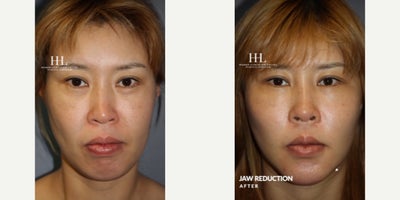 Woman treated with Jaw Reduction - Woman treated with Jaw Reduction