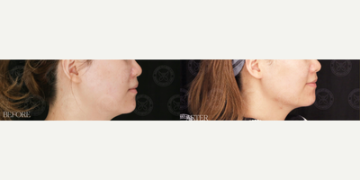 Woman treated with Mesotherapy - Woman treated with Mesotherapy